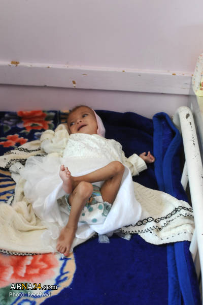 شدیدترین بحران غذایی جهان در یمن