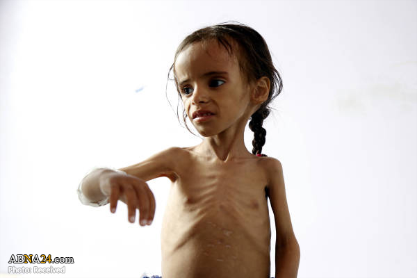 سوءتغذیه شدید دختربچه یمنی