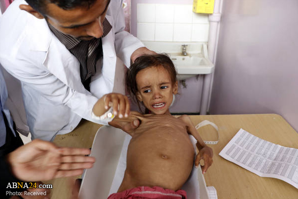 سوءتغذیه شدید دختربچه یمنی