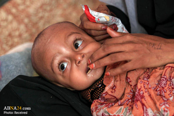 سوءتغذیه کودکان یمنی در صنعاء